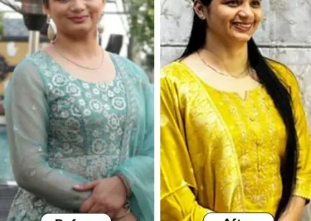 Patient Overcame PCOS and Lost 14 Kg